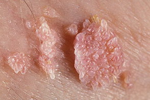 Human Papilloma Virus (HPV) - Invitro Diagnostics